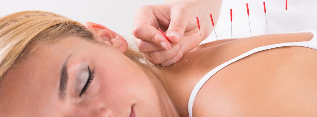 woman receiving acupuncture treatment